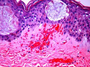 H&E 400×; focally necrotic keratinocytes, spongiotic vesicles, vascular thrombosis and red blood cell extravasation.