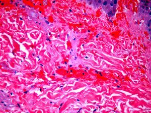 H&E 400×; thrombosed vessel and red blood cell extravasation.