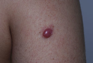 Isolated nodule on the arm of a patient with primary cutaneous marginal zone B-cell lymphoma.
