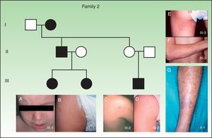 Clinical characteristics of family 2. A, Capillary malformation on the right cheek of patient 2, an 18-month-old girl. B, Smaller capillary malformations distributed randomly over the body of the same patient. C and D, Several smaller, less apparent capillary malformations on the patient's older sister. E and F, Large capillary malformations on a male cousin of the patient. G, Arteriovenous malformation on the right lower limb of the patient's father.