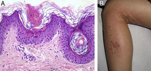 A, Observe the cornoid lamella—a column of stacked parakeratotic cells extending through the stratum corneum characteristic of porokeratosis. Hematoxylin-eosin, original magnification ×100. B, Large erythematous, edematous lesions on the left leg on the area where PDT treatment was applied.
