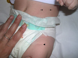 Cutaneous scars on the abdomen (←) and right thigh (¿).