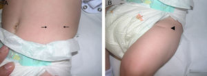 A, Two dimples on the left side of the abdomen (←). B, Linear depression on the front of the left thigh (¿).