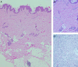 A, Low-magnification view, epidermis with 2 scalloped areas and compact, wide dermis with few adnexa (hematoxylin-eosin, original magnification ×20). B, In greater detail, thin collagen bundles in the dermis (hematoxylin-eosin, original magnification ×100). C, Fragmented and reduced elastic fibers in the dermis (orcein staining, original magnification ×100).