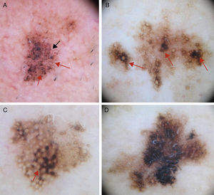 A, Dermoscopic image of early-phase lentigo maligna showing irregularly distributed slate-gray dots and globules (red arrows), short dark streaks, early rhomboidal structures (black arrow), and asymmetric perifollicular pigmentation (asterisks). B, Dermoscopic image of lentigo maligna showing follicular openings with asymmetric pigmentation, some of which have signs of early obliteration (red arrows). C, Image showing isobar structures (asterisk), rhomboidal structures (red arrow), and follicular openings with asymmetric pigmentation. D, Image of histologically confirmed lentigo maligna melanoma following biopsy taken of area marked by the asterisk, showing homogeneous areas with obliterated follicular openings.