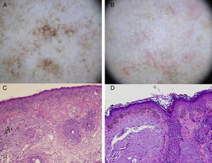 A, Dermoscopic image of lentigo maligna (rhomboidal structures asymmetric perifollicular pigmentation, and granular pattern with asymmetrically distributed irregular globules). B, Dermoscopic image of pigmented actinic keratosis (multiple similarly shaped and colored brown-gray dots with a predominantly perifollicular distribution, and rhomboidal structures). C, Histologic image (hematoxylin-eosin, original magnification ×100) of the lesion in Figure 3A, showing proliferation of atypical melanocytes along the dermal-epidermal junction with involvement of the perifollicular epithelium. Melanophages and solar elastosis can also be observed in the dermis. D, Histologic image (hematoxylin-eosin original magnification ×100) of the lesion in Figure 3B, showing atypical pigmented keratinocytes at the dermal-epidermal junction and solar elastosis in the dermis.