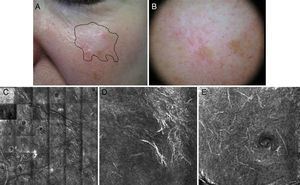 Seventy-year-old man with recurrent lentigo maligna in a cryotherapy scar on the left cheek; no previous biopsy. Confocal reflectance microscopy (CRM) showing the presence of atypical cells, compatible with the diagnosis of lentigo maligna, confirmed by biopsy. A, A hypochromatic scar lesion, possibly due to cryotherapy, with slight, nonspecific light brown pigmentation. Visualization of the positive margins provides a guide for treatment. B, Dermoscopic image of a lesion with a homogeneous pigmented pattern without signs of malignancy. The lesion has a scar that distorts the structure of the skin in the area and erases the typical pseudonetwork pattern; the image is therefore not informative. C, CRM in vivo (VivaScope 1500). Mosaic in the stratum spinosum showing typical honeycomb pattern and abundant hyperrefractile linear structures at low magnification consistent with the characteristic dendritic melanocytic of lentigo maligna melanoma. D, Image of the spinous stratum, showing an area 500μm×500μm with atypical hyperrefractile dendritic cells. E, Image of the stratum granulosum, showing an area 500μm×500μm with atypical dendritic cells consistent with pagetoid melanocytes. (Images were kindly provided by Dr Josep Malvehy of Hospital Clínic de Barcelona.)