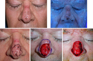 Sixty-five-year-old man with lentigo maligna. A, The lesion on the nasal dorsum. B, Under Wood