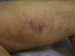 Red-violaceous, racemose, macular skin lesions on the inner thigh, consistent with livedo reticularis.