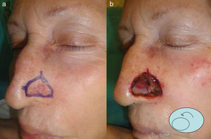 A and B, Recurrent basal cell carcinoma of the left nasal ala and the surgical defect left after 2 stages of Mohs micrographic surgery. The diagram shows the rotation of the myochondromucosal flap from the adjacent ala.