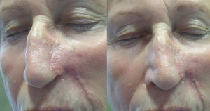 Result 8 weeks after the surgical intervention.