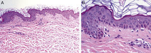 A, In the epidermis, increased pigmentation in cells of the basal layer (hematoxylin-eosin, original magnification × 100). B, Higher magnification, cytoplasmic pigmentation in cells of the basal epidermal layer (hematoxylin-eosin, original magnification × 400).