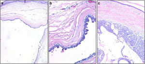 Histologic images (hematoxylin-eosin, original magnification ×20). A and B, Dermal cysts enveloped in a double layer of cuboidal cells. Well-defined tumor composed of cells with abundant eosinophilic cytoplasm and other cells of a more basaloid appearance. C, Cystic structures in the center of the lesion.