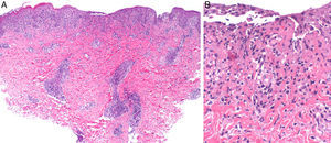 A, Deep perivascular lymphohistiocytic inflammatory infiltrate with involvement of the dermal-epidermal junction (hematoxylin-eosin, original magnification ×10). B, Detail showing interface alteration, fibrinoid necrosis in the vessel walls, and isolated necrotic keratinocytes (hematoxylin-eosin, original magnification ×40).