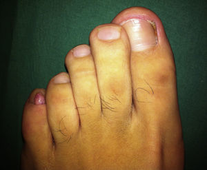 Acral fibrokeratoma on the fifth toe of the left foot.