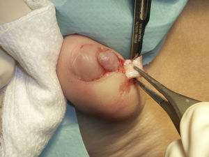 Banner flap: 2 longitudinal incisions are made into the proximal nail fold, one on either side of the lesion.
