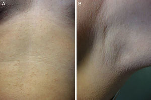 A, Multiple minute nonconfluent red-to-yellow papules on the chest and abdomen. B, The axillae were not involved.