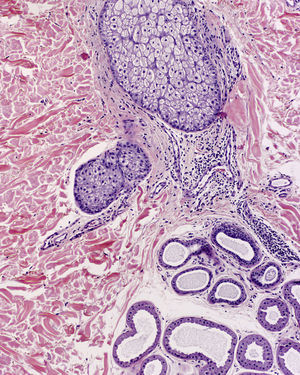 Chronic periadnexal lymphocytic inflammatory infiltrate and dilated clusters of apocrine cells (hematoxylin-eosin, original magnification ×50).