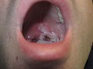 Irregular whitish plaque on the soft palate.