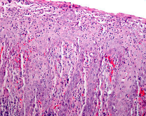 Biopsy of soft palate showing a marked neutrophilic exudate with signs of epithelial regeneration and a slight inflammatory infiltrate (hematoxylin-eosin, original magnification × 200).