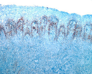Immunohistochemical staining of biopsy samples with polyclonal antibody against Treponema pallidum (Biocare Medical), showing abundant spirochetes in the epithelium and fewer spirochetes in the underlying chorion (original magnification × 100).