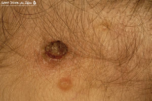 Three molluscum contagiosum lesions in a newborn. Occipital region.