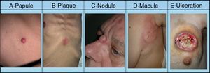 Skin metastases can manifest as primary or secondary skin lesions. A, Metastasis from a gastric adenocarcinoma. Papule of 7mm diameter on the abdomen. B, Metastasis from an adenocarcinoma of the ovary presenting as a plaque. C, Metastasis from a urothelial carcinoma of the bladder presenting as a nodule. D, Metastasis from an adenocarcinoma of the breast. The lesion started as a macule over the mastectomy scar. E, Ulcerated infiltrated plaque corresponding to a metastasis from an adenocarcinoma of the lung.