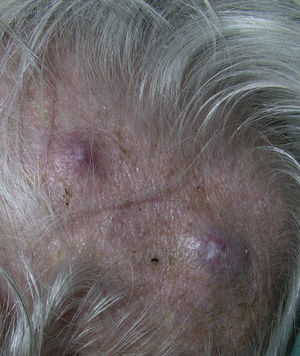 Metastases from a follicular thyroid carcinoma. Violaceous nodules on the scalp with superficial telangiectasias.