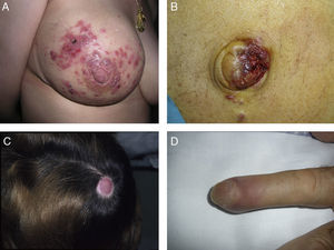 Unusual skin metastases. A, Zosteriform metastases from a ductal adenocarcinoma of the breast. Clusters of infiltrated papules, some confluent and some ulcerated, in a metameric distribution. B, Umbilical metastasis (Sister Mary Joseph's nodule); multiple, confluent, ulcerated papules and nodules in the umbilical and periumbilical regions. C, Alopecia neoplastica. Plaque of alopecia over a metastasis from a ductal adenocarcinoma of the breast in a woman. D. Subungual metastasis. Metastasis from a squamous cell carcinoma of the lung presenting as a painful inflammatory nodule that deformed the distal phalanx of the second finger of the left hand.