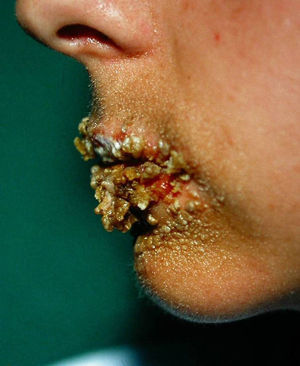 Crusting sores on the lips of a patient with anorexia nervosa.