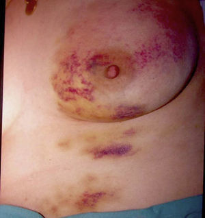 Painful bruising in a 36-year-old woman with a severe psychological disorder.