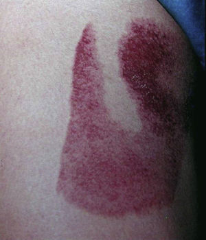 A burn probably caused by an iron.