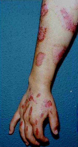 Burns on the upper right limb of a left-handed patient.