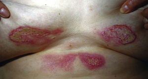 Burns on breasts and mirrored lesions on the submammary region.