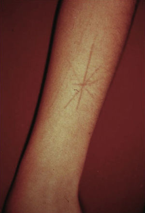 Linear excoriations on the forearm of a girl in a star pattern.