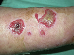 Ulcers with “capricious” shapes on a man's forearm.