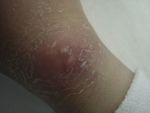 Panniculitis on the wrist and the dorsum of the hands caused by injection of a silicone material.
