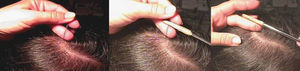 The trichogram: sample collection and preparation.