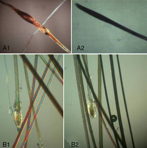 Hair shaft examination: uniformity. A1, Pseudomonilethrix. A2, Trichorrhexis nodosa in alopecia areata. B1 and B2, Differences in shafts in androgenetic alopecia with telogen hairs (seen as the shortest and finest hairs).
