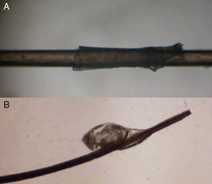 Substance deposits on hair shaft. A, Hair with a peripilar cast. B, Pediculosis capitis. Optical microscopy (original magnification ×40).