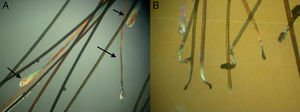 Androgenetic alopecia. A, Different hair shaft diameters and finer, shorter telogen hairs (arrow). B, Dystrophic hairs. Polarized light microscope (original magnification ×10).