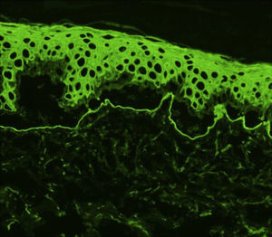 Indirect immunofluorescence using 1.0M sodium chloride-separated skin. Antibodies are targeting the dermal side (floor) of the blister. Original magnification ×200.