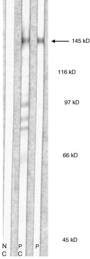 Immunoblot of recombinant proteins (patient 3). The 145-kDa band corresponds to the NC1 domain of type VII collagen. NC refers to negative control; PC, positive control; P, patient's serum.