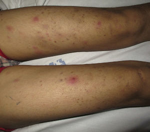 Erythematous nodules affecting both thighs of a patient with erythema nodosum leprosum (type 2 leprosy reaction).