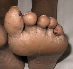 Distal purpuric lesions in a patient with erythema nodosum leprosum (type 2 leprosy reaction).