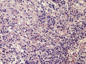 Lymphocytic, neutrophilic, and histiocytic infiltrate in the deep dermis in a patient with erythema nodosum leprosum (hematoxylin-eosin, original magnification ×40).