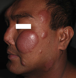 Erythematous, edematous facial plaques in a patient with a type 1 leprosy reaction.