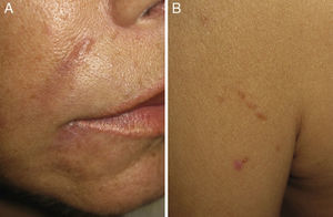 A, Clinical appearance of nodules in a nasolabial fold. B, Clinical appearance of linear papules on an old scar.