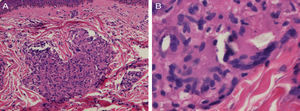 A, Histopathology of a papule from the shoulder. Sarcoid granulomas are visible in the reticular dermis (hematoxylin and eosin, original magnification, ×200). B, Detail of shiny particles in the cytoplasm of multinucleated giant cells (hematoxylin and eosin, original magnification, ×400).