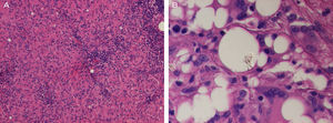 A, Histopathology of the left axillary lymph node showing widespread sarcoid granulomas (hematoxylin and eosin, original magnification, ×200). B, The center of the node contains clear vacuoles in the extracellular space and in the cytoplasm of multinucleated giant cells. Note the refractile material within these vacuoles (hematoxylin and eosin, original magnification, ×400).
